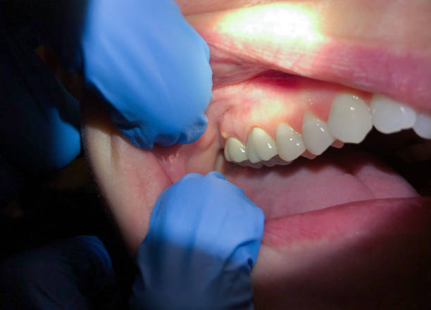 Best Broken or Cracked Tooth Emergency Dentist in Iselin, NJ